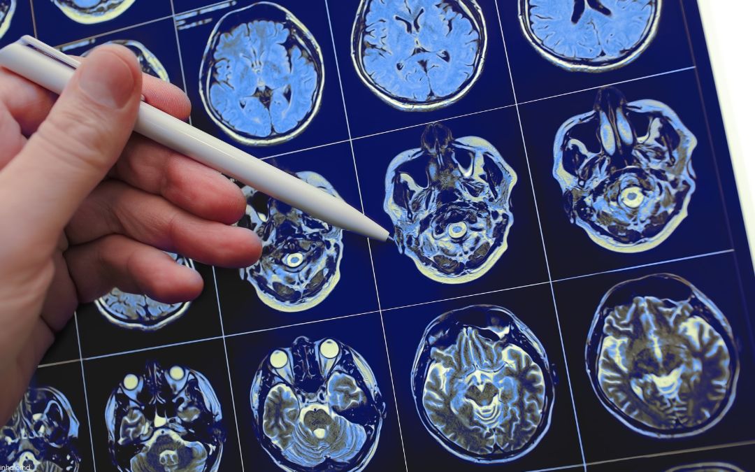 How Marijuana Treats Seizures